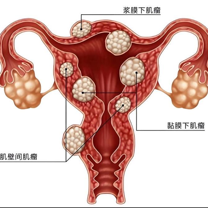 子宫肌瘤的症状表现有哪些？泰安俪人医院来讲解
