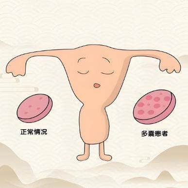 女性患有多囊卵巢后的症状表现是什么？这些全是干货