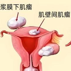 哪些原因引发的女性子宫肌瘤？泰安俪人医院来介绍