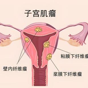 泰安俪人医院介绍引发女性子宫肌瘤的原因