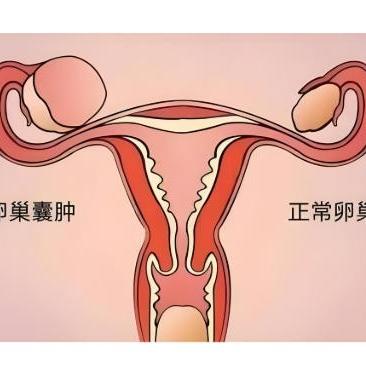 卵巢囊肿是一种什么病？患上它后严重吗？