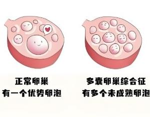 多囊卵巢综合症的引发原因有哪些？