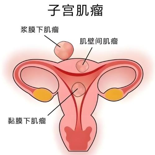 女性子宫肌瘤严重吗？这几个地方要重点关注下