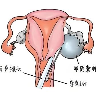 泰安俪人医院介绍女性患有卵巢囊肿后有哪些症状表现