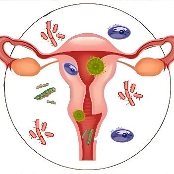 容易引起女性盆腔炎的几个原因是什么？