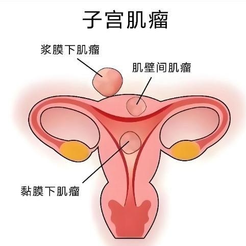 女性子宫肌瘤的症状具体有哪些？