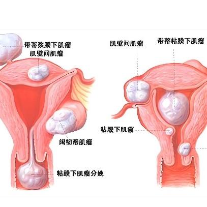 哪些原因会引发女性患子宫肌瘤呢？