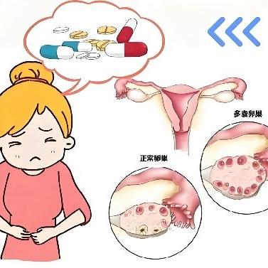 女性多囊卵巢综合症的检查包括哪些？