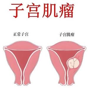 女性子宫肌瘤的诱发原因都有哪些？