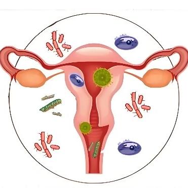 引发女性盆腔炎的原因具体有哪些？