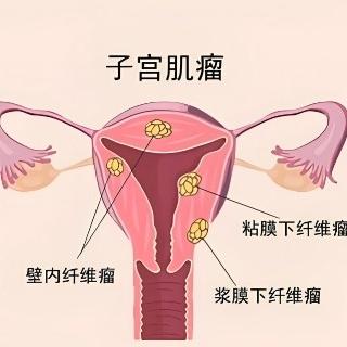 女性朋友们患有子宫肌瘤后都有哪些症状表现呢？