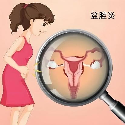 女性盆腔炎的症状表现主要表现在哪个方面?