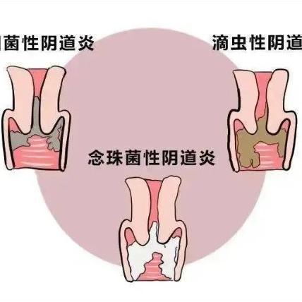 为大家讲述女性患阴道炎的几个原因所在