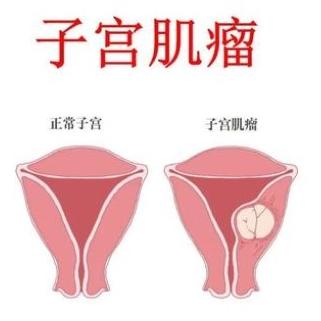 女性患有子宫肌瘤的原因有哪些？