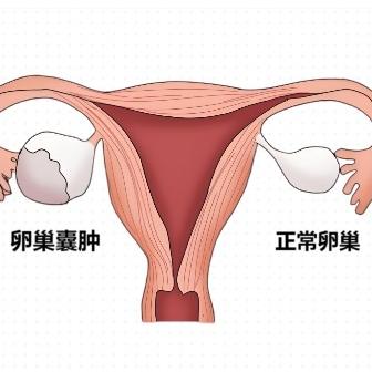 女性患有卵巢囊肿之后会影响怀孕吗？