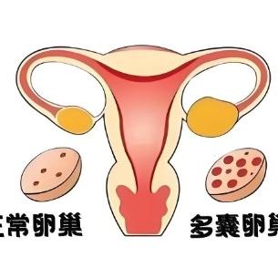 女性多囊卵巢综合症的表现都有哪些？