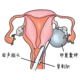 你知道患有卵巢囊肿之后要些项目吗？