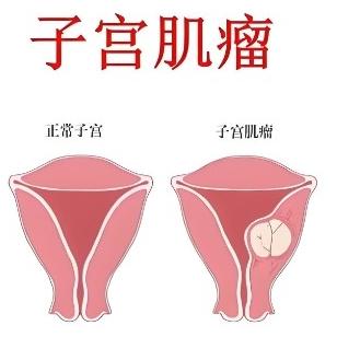 女性子宫肌瘤的症状表现是什么？