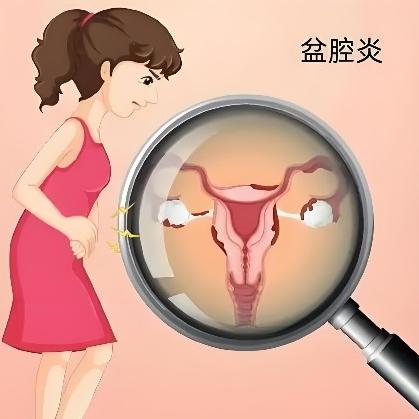 别慌，得了盆腔炎后不是事！了解症状是关键！