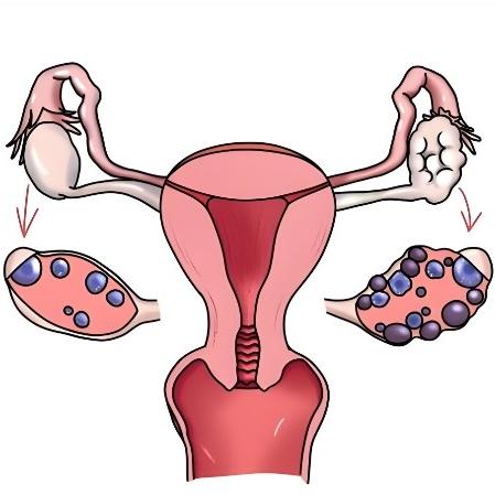卵巢囊肿会影响女性怀孕吗？