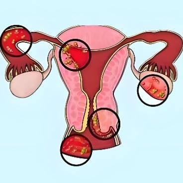 盆腔炎的病因都与哪些因素有关？