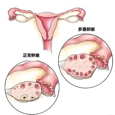 多囊卵巢患者要注意哪些方面？