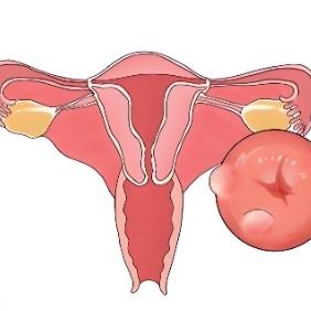 泰安俪人医院介绍子宫囊肿要注意哪些地方