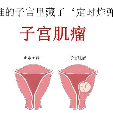 女性朋友们患上子宫肌瘤后有哪些症状表现？