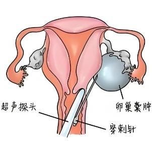 女性卵巢囊肿的危害表现有哪些？这几点要注意