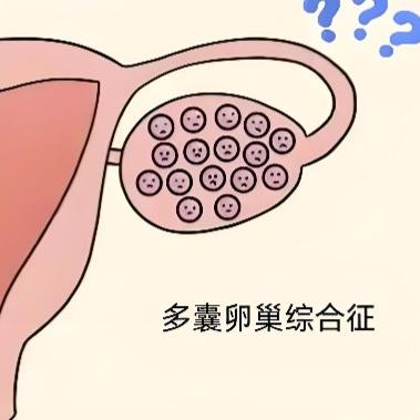 多囊卵巢综合症的表现都有哪些？