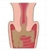 女性阴道炎的症状表现具体有哪些？