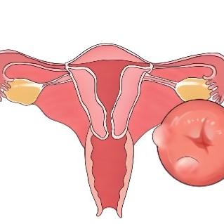 患有子宫囊肿后的注意事项是什么？