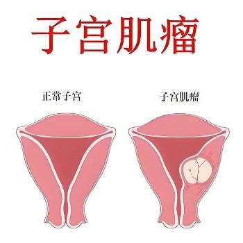子宫肌瘤的症状表现有哪些？