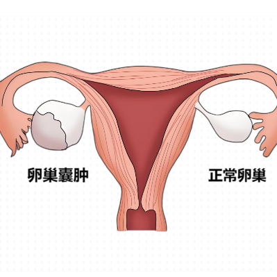 患有卵巢囊肿的女性一般表现症状是什么？