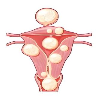 患子宫肌瘤后要注意哪些方面