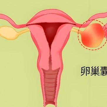 卵巢囊肿的主要检查项目包括哪些内容？