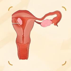 女性患子宫囊肿后要怎么处理才好？