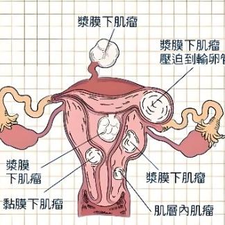 女性患有子宫肌瘤后要注意哪些地方？
