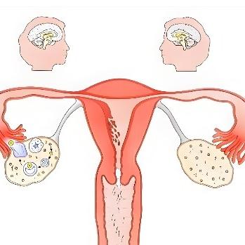 多囊卵巢综合症的原因具体有哪些？