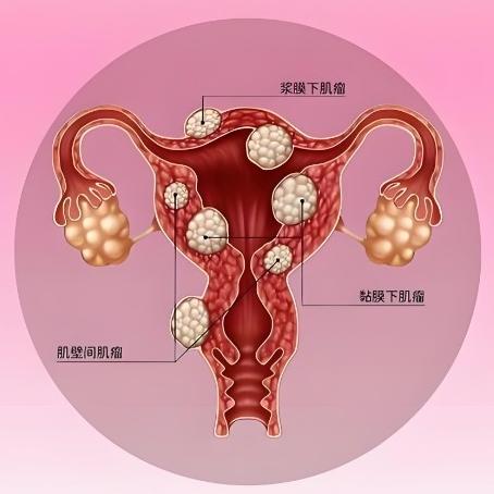 子宫肌瘤的症状表现具体指什么？