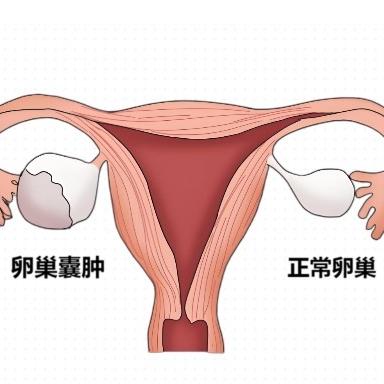 能引发女性卵巢囊肿的原因都有哪些？