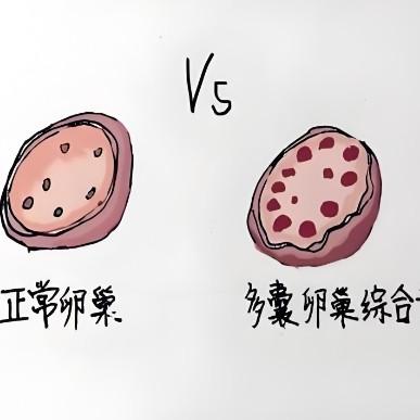 多囊卵巢综合症的原因都有哪些？