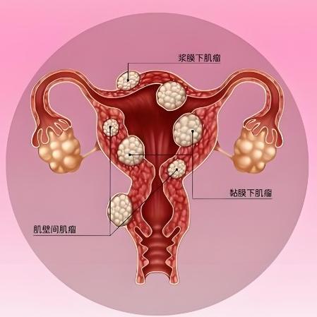 子宫肌瘤的症状表现具体都有哪些？