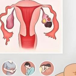 卵巢囊肿的症状表现具体指什么？这些地方得多关注！