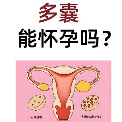 泰安俪人医院专家讲述女性患有多囊卵巢后是否容易怀孕