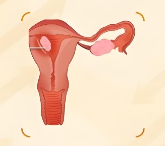 子宫囊肿的特征是什么？这些细节得提前了解