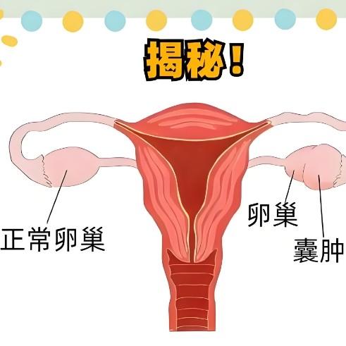 卵巢囊肿的症状表现具体都有哪些？