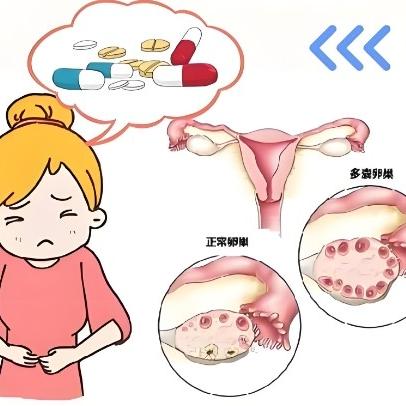 泰安俪人妇产医院为大家详细讲解什么是多囊卵巢综合症