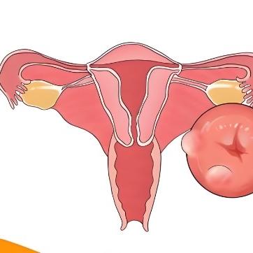 子宫囊肿是一种什么病？这些症状表现要认清