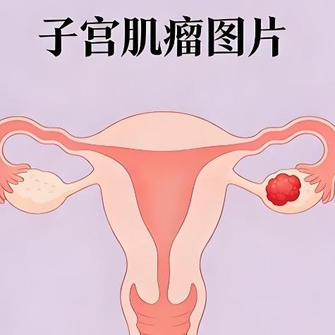 子宫肌瘤的症状表现具体还有哪些？